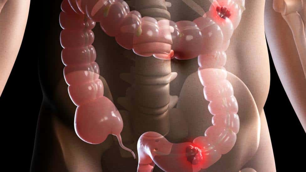 Crecen los casos de cáncer de colon en menores de 50 años: piden reforzar la prevención y los controles